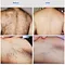 Permanent hair removal